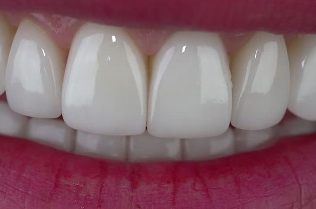 Perfect Dental Veneers from Mckellparcker dental