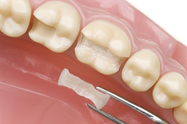 dental-inlay-image1