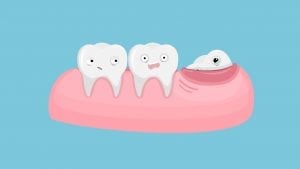 A comical illustration of a wisdom tooth erupting through the gum tissue