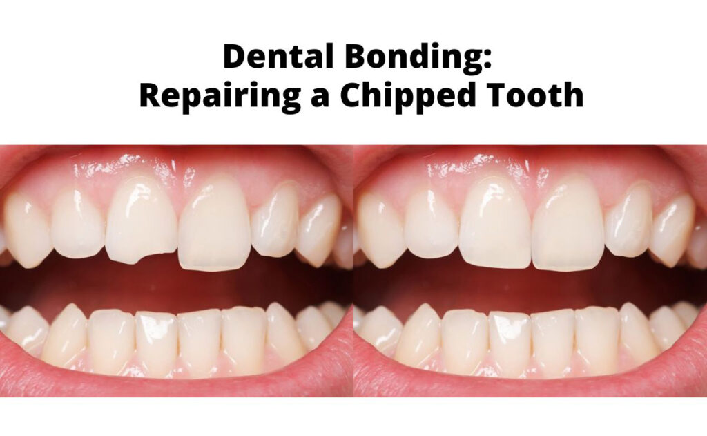 Pictures of a chipped tooth and a repaired tooth with dental bonding