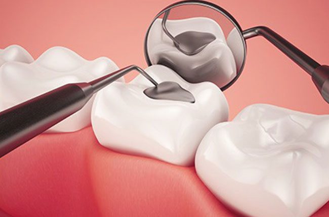 dental fillinfs in mckellparker dental