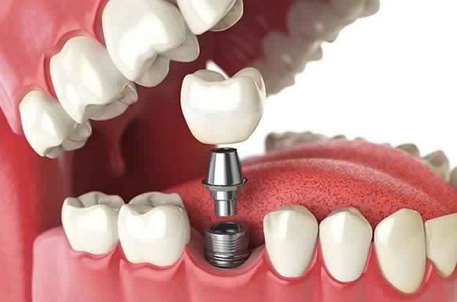 digital image showing a perfect dental implants in mckellparker dental