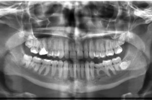 Digital X-ray caught by mckellpacker dental