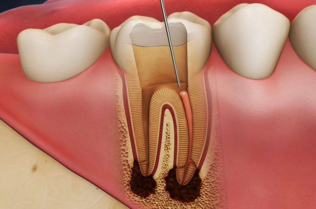 root canal procedure - mckell and packer dental